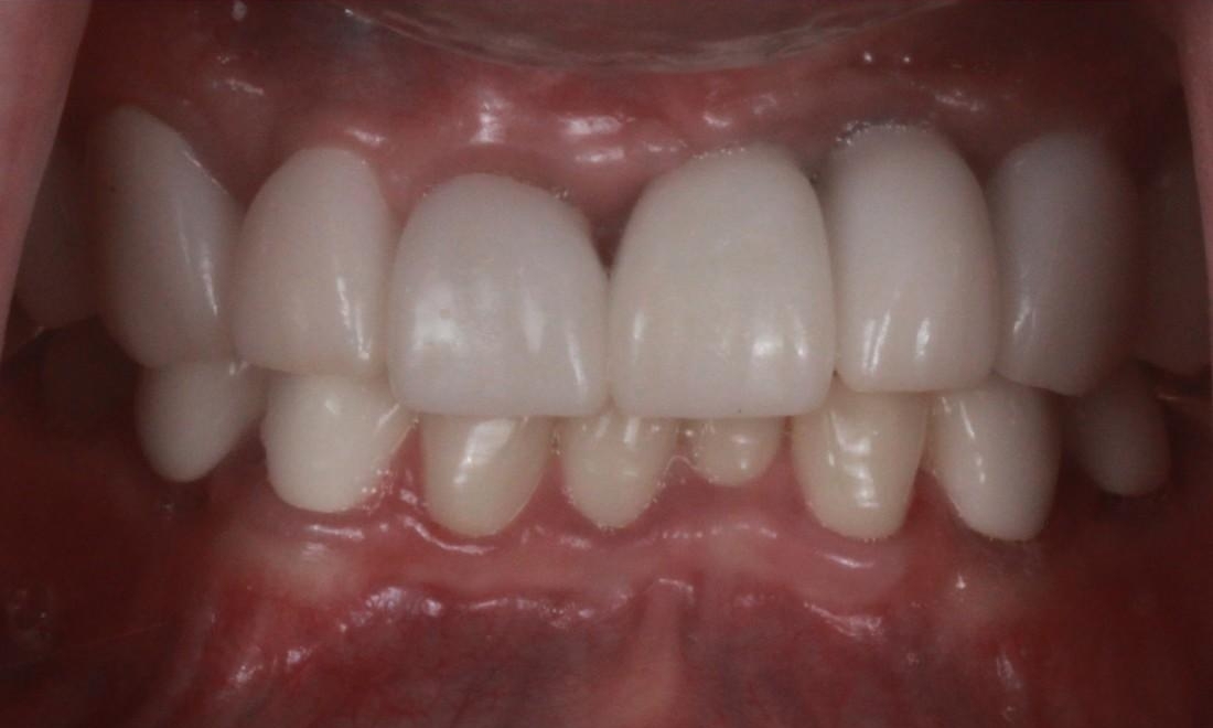 Tooth Repair in Lafayette | Before & After