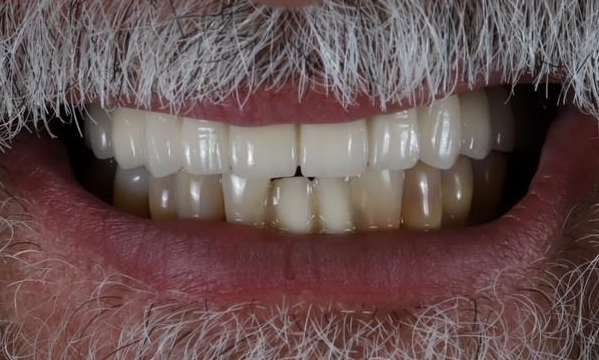 Dental Implants in Lafayette | Before & After