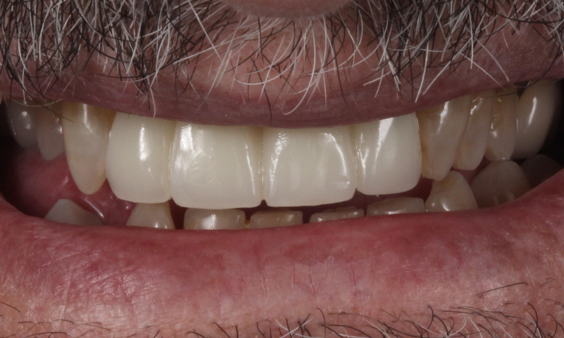 Tooth Repair in Lafayette | Before & After