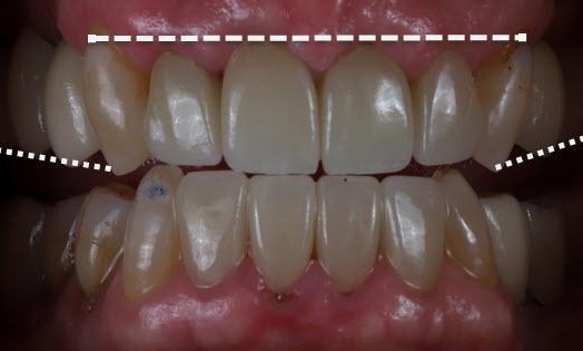 Dental Crowns in Lafayette | Before & After