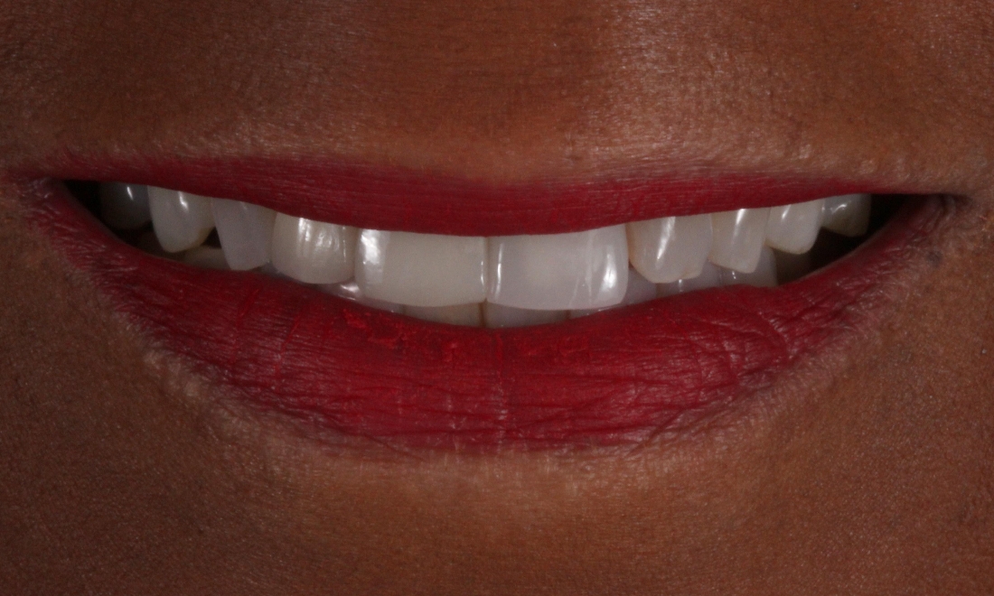 Smile Makeovers in Lafayette | Before & After