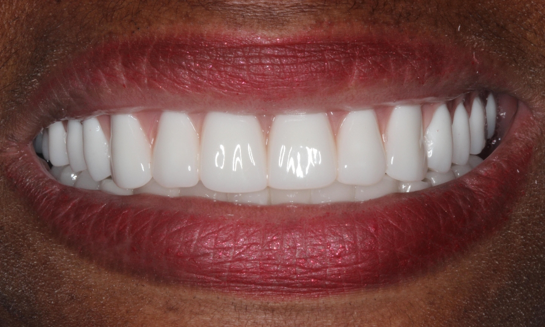 Smile Makeover in Lafayette | Before & After