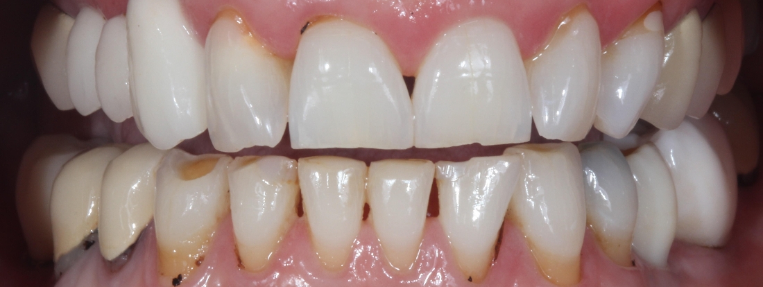 Smile Makeovers in Lafayette | Before & After