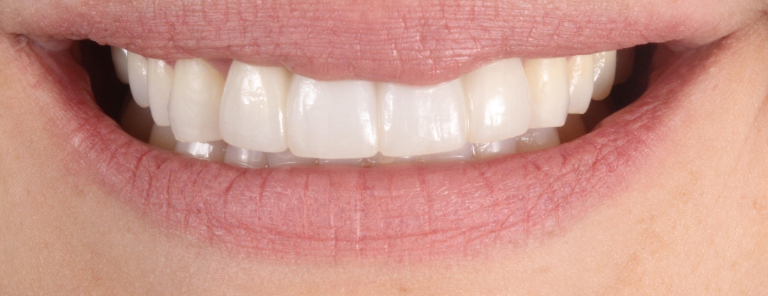 Smile Makeovers in Lafayette | Before & After