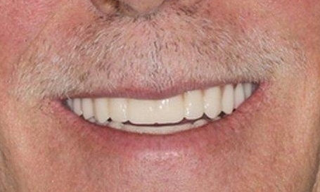Smile Makeovers in Lafayette | Before & After