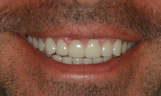 Smile Makeovers in Lafayette | Before & After