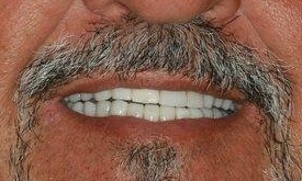 Tooth Restorations in Lafayette | Before & After