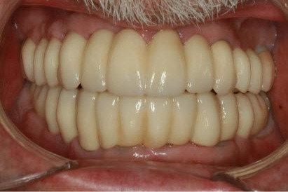Tooth Replacement in Lafayette | Before & After
