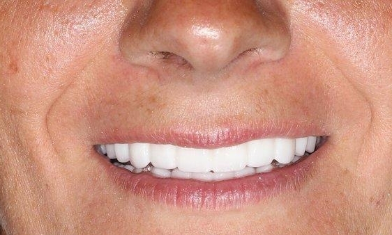 Tooth Replacement in Lafayette | Before & After
