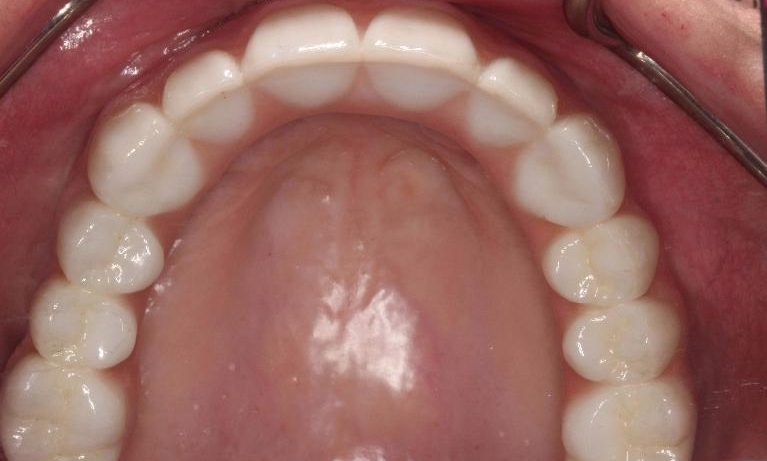 Modern Dentures in Lafayette | Before & After