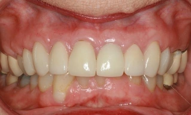Teeth Restorations in Lafayette | Before & After