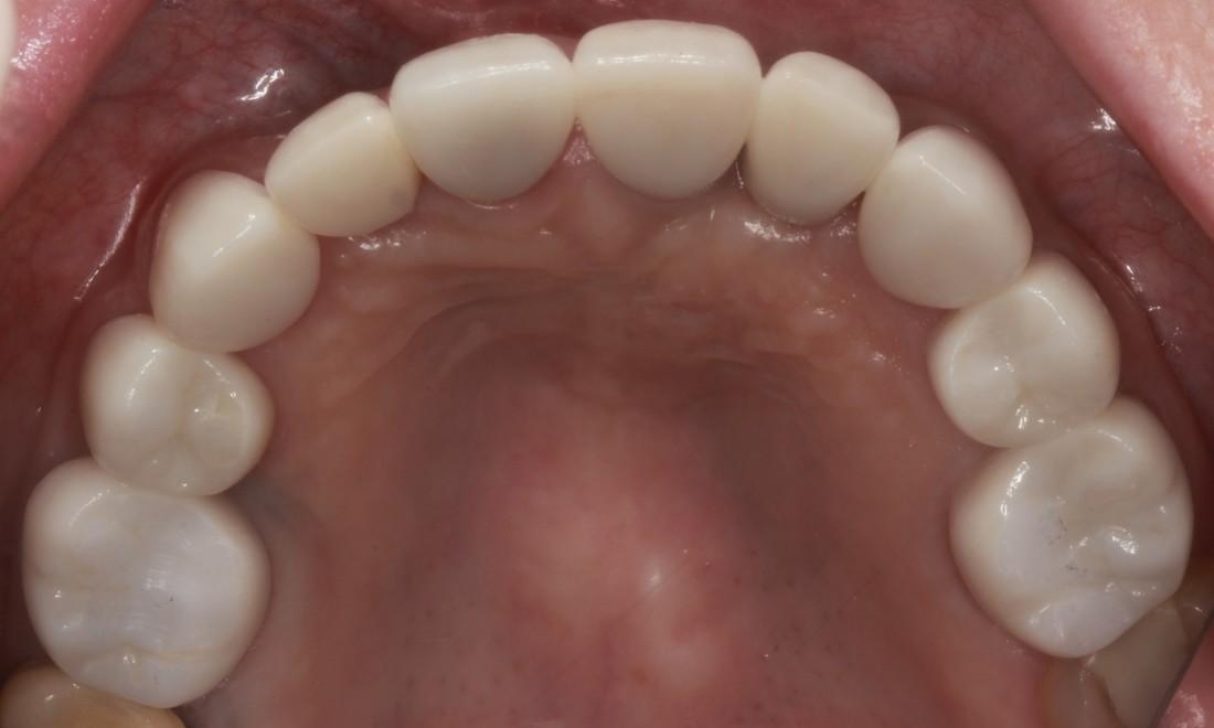 Tooth Repair in Lafayette | Before & After