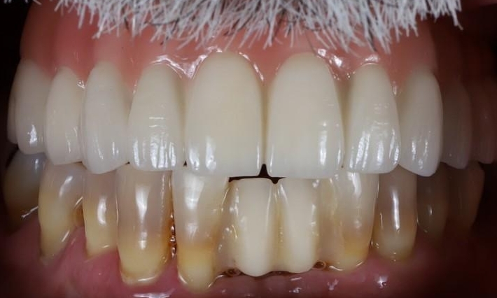 Dental Implants in Lafayette | Before & After