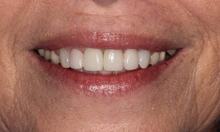 Smile Makeovers in Lafayette | Before & After