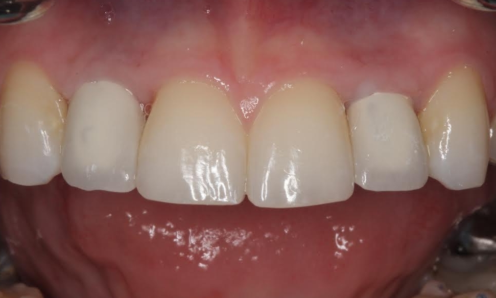 Smile Makeovers in Lafayette | Before & After