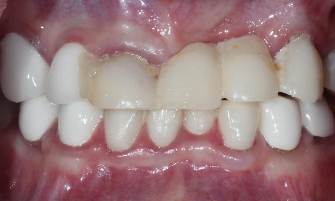 Tooth Repair in Lafayette | Before & After