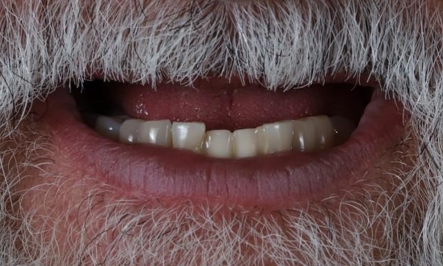 Dental Implants in Lafayette | Before & After