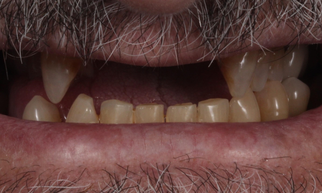 Tooth Repair in Lafayette | Before & After