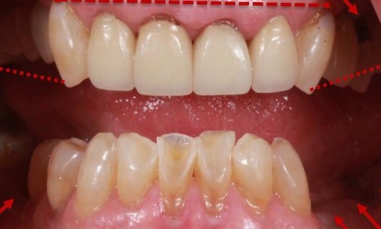 Dental Crowns in Lafayette | Before & After