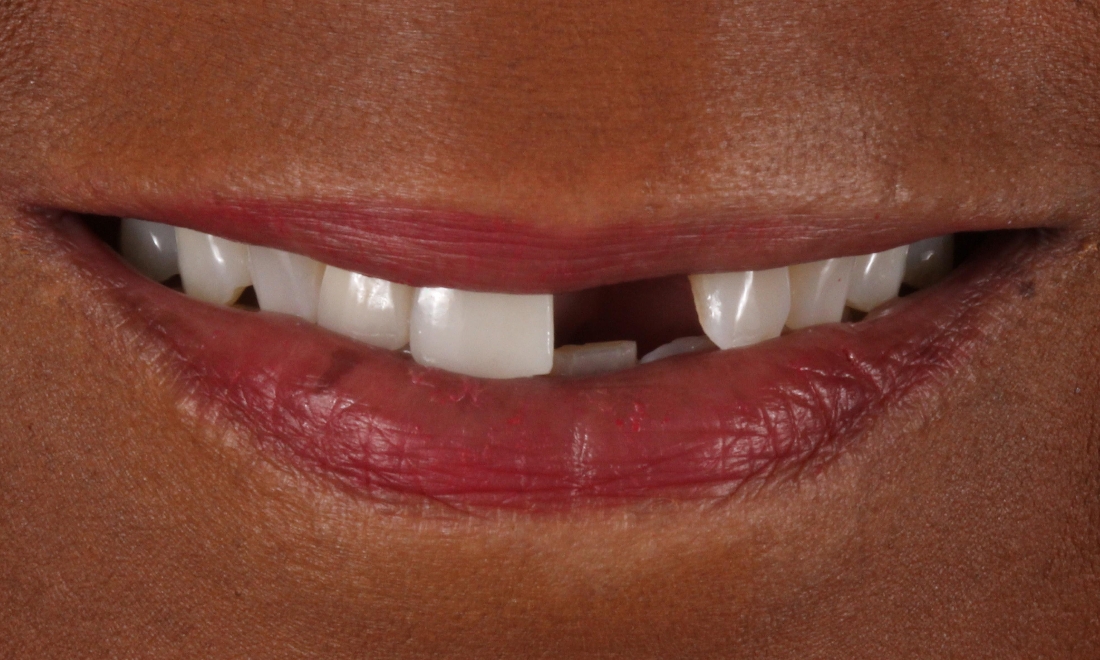 Smile Makeovers in Lafayette | Before & After