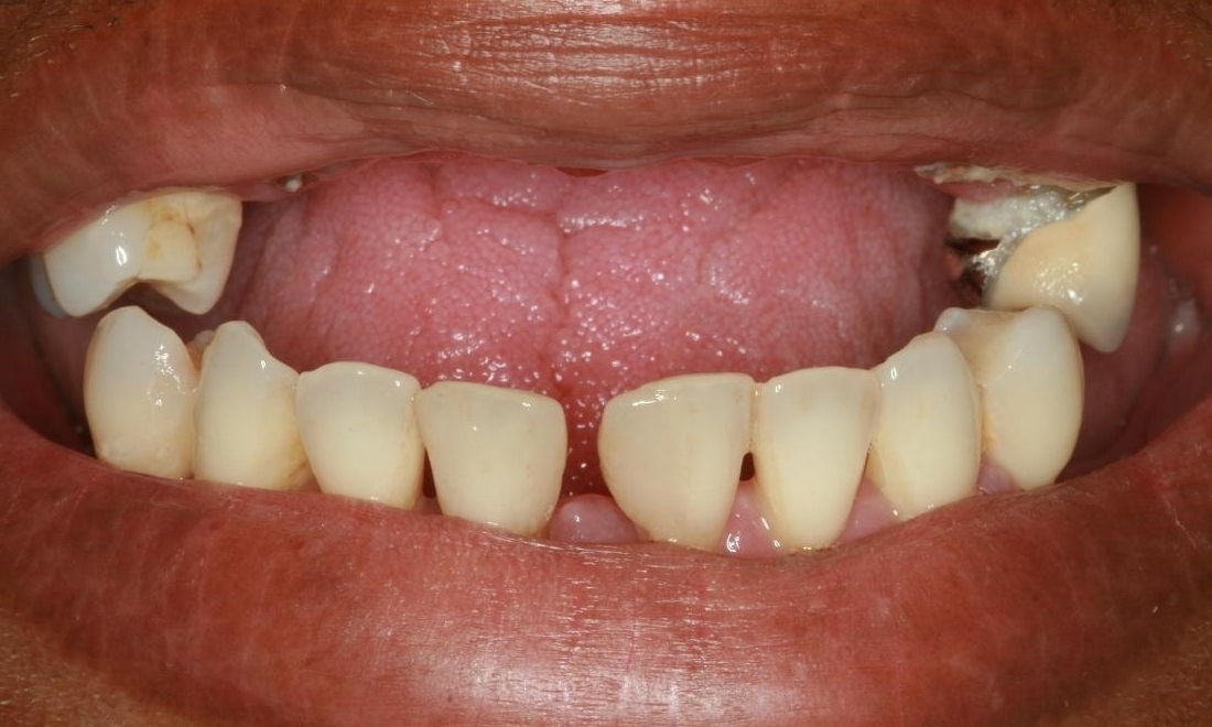 Smile Makeover in Lafayette | Before & After