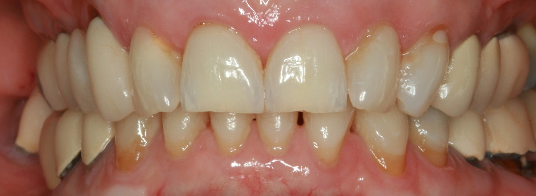 Smile Makeovers in Lafayette | Before & After