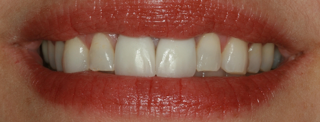 Smile Makeovers in Lafayette | Before & After