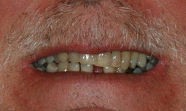 Smile Makeovers in Lafayette | Before & After