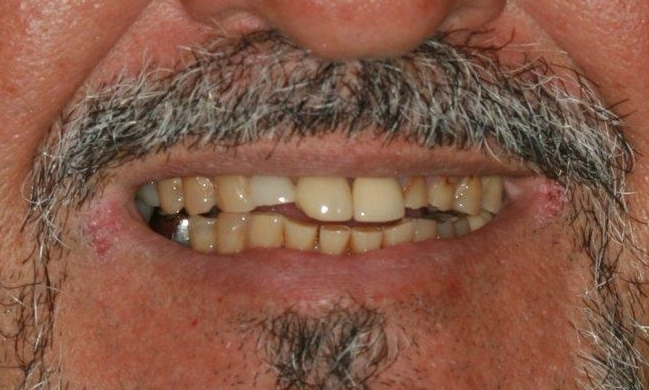 Tooth Restorations in Lafayette | Before & After