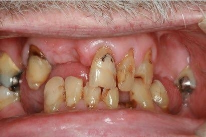 Tooth Replacement in Lafayette | Before & After