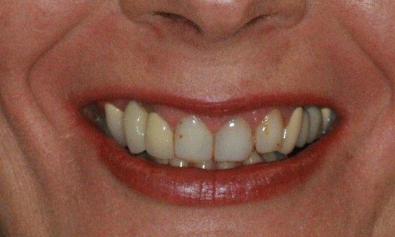 Tooth Replacement in Lafayette | Before & After