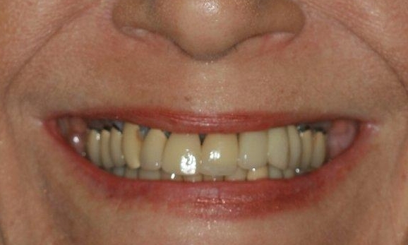 Tooth Repair and Fix in Lafayette | Before & After