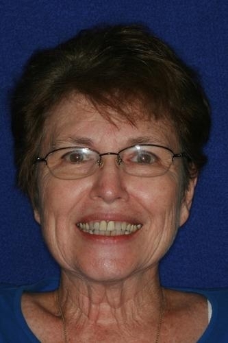 Teeth Restorations in Lafayette | Before & After