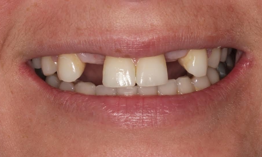 Smile Makeovers in Lafayette | Before & After