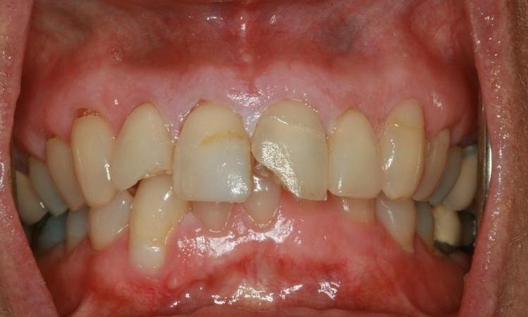 Teeth Restorations in Lafayette | Before & After