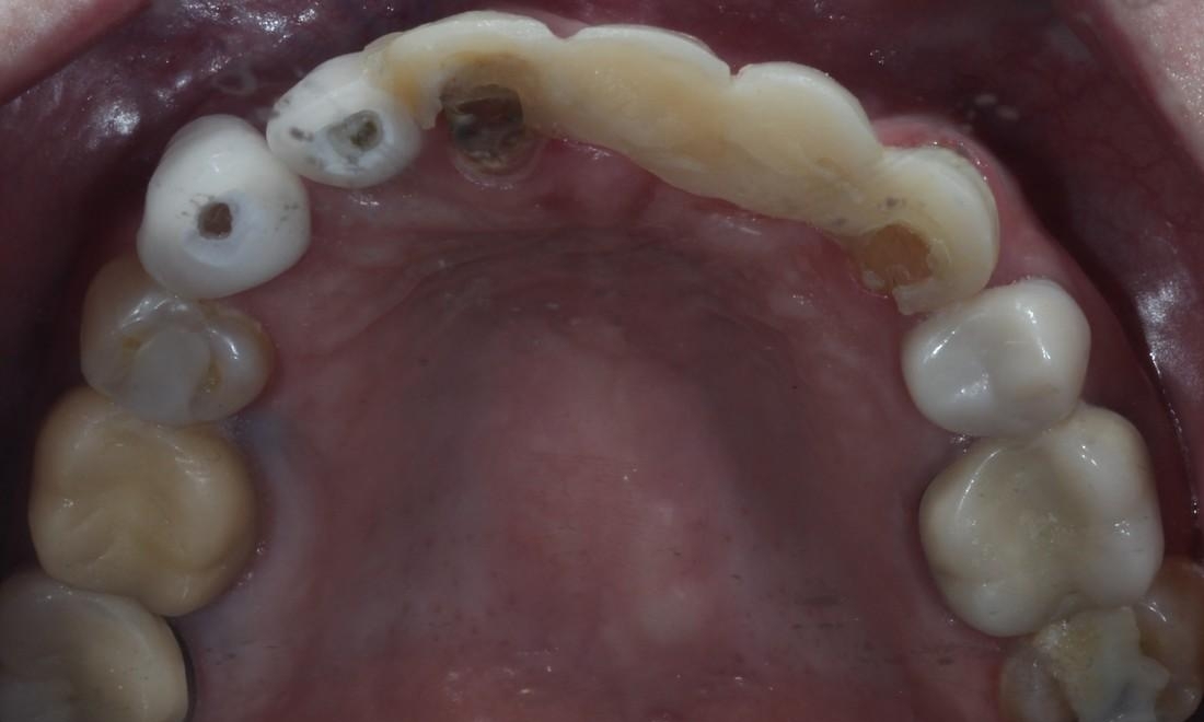 Tooth Repair in Lafayette | Before & After