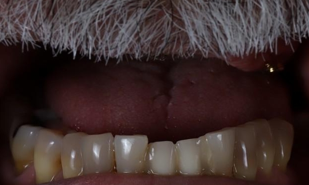 Dental Implants in Lafayette | Before & After