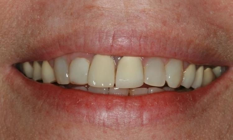 Smile Makeovers in Lafayette | Before & After