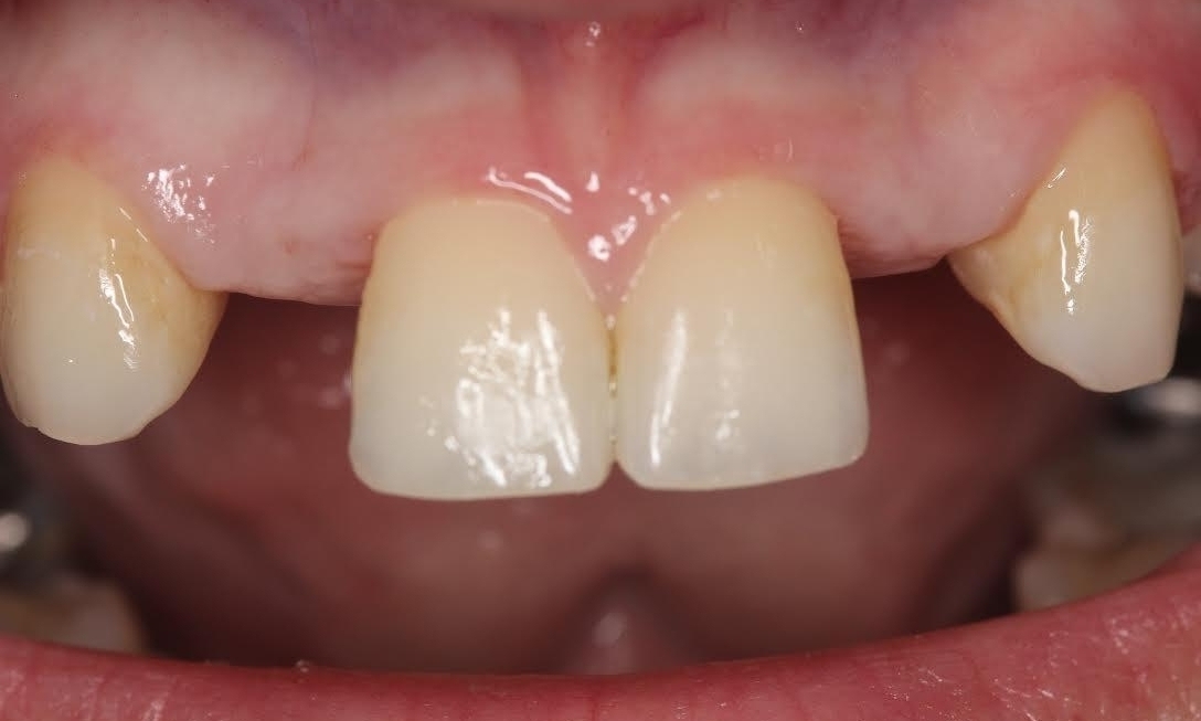 Smile Makeovers in Lafayette | Before & After