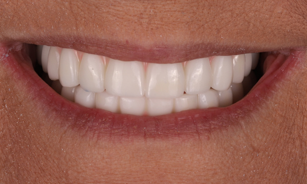 Smile Makeover in Lafayette | Before & After