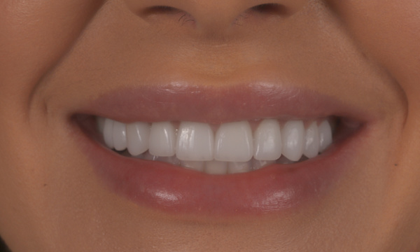 Tooth Restorations in Lafayette | Before & After