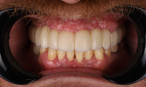 Tooth Replacement in Lafayette | Before & After