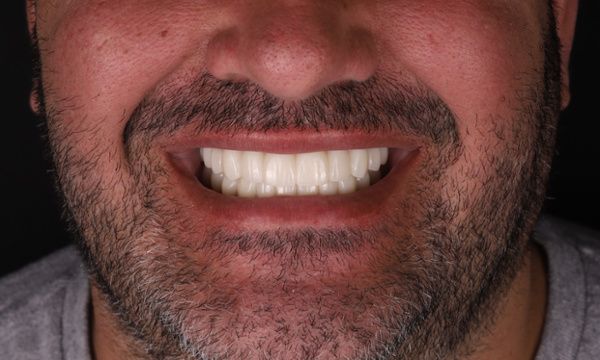 Tooth Repair in Lafayette | Before & After