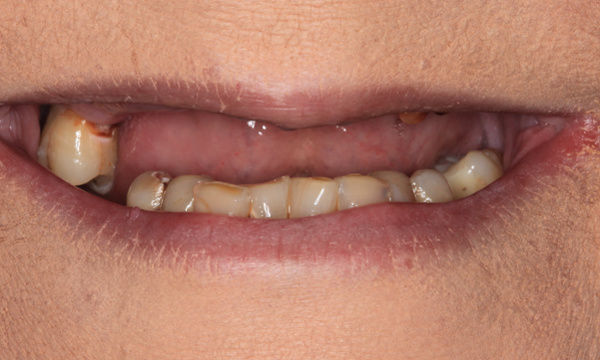 Smile Makeover in Lafayette | Before & After