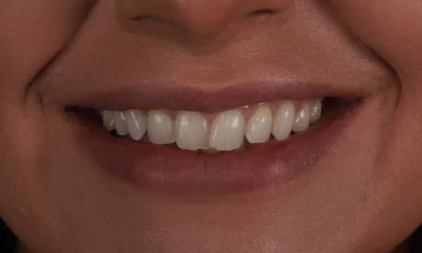 Tooth Restorations in Lafayette | Before & After