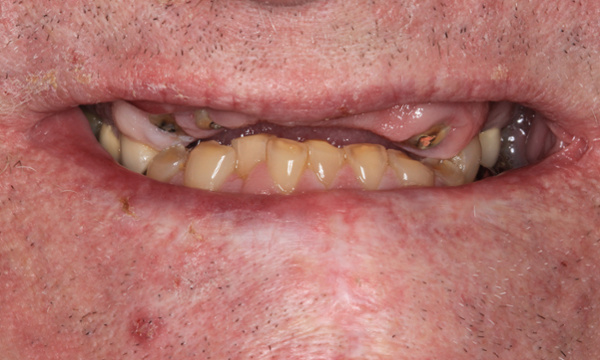 Tooth Replacement in Lafayette | Before & After