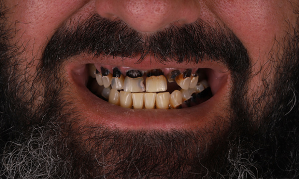 Tooth Repair in Lafayette | Before & After