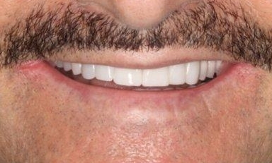 Smile Makeovers in Lafayette | Before & After