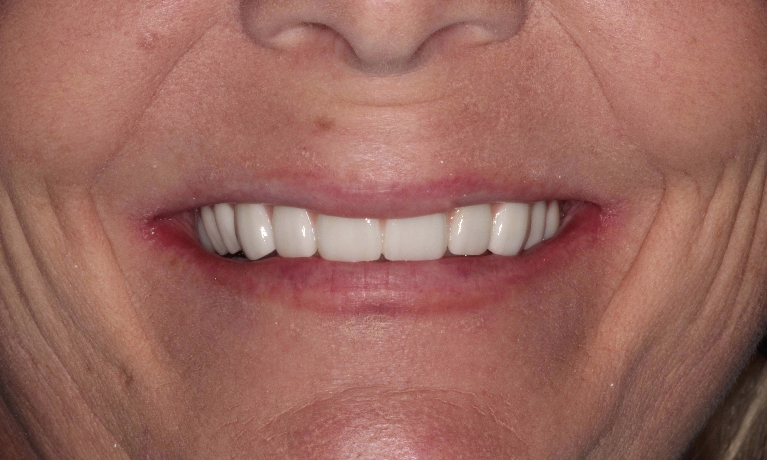 Fixed-Permanent-Implant-Bridge-After-Image