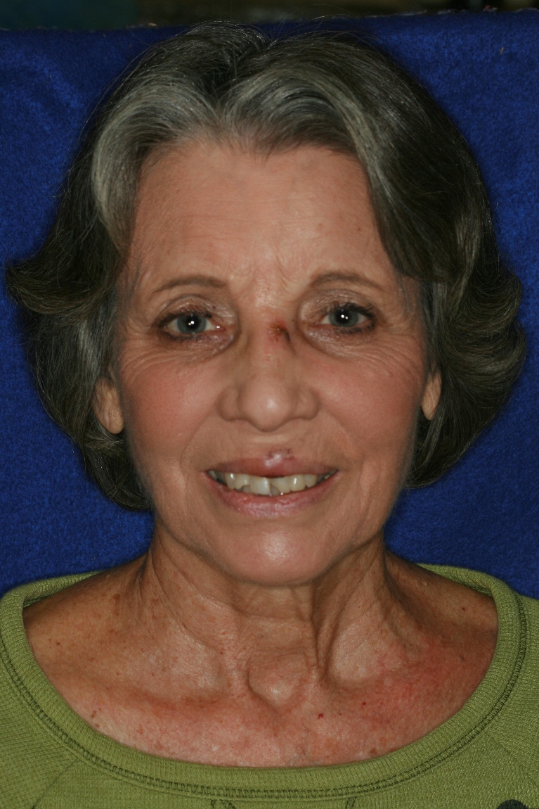 Teeth Restorations in Lafayette | Before & After